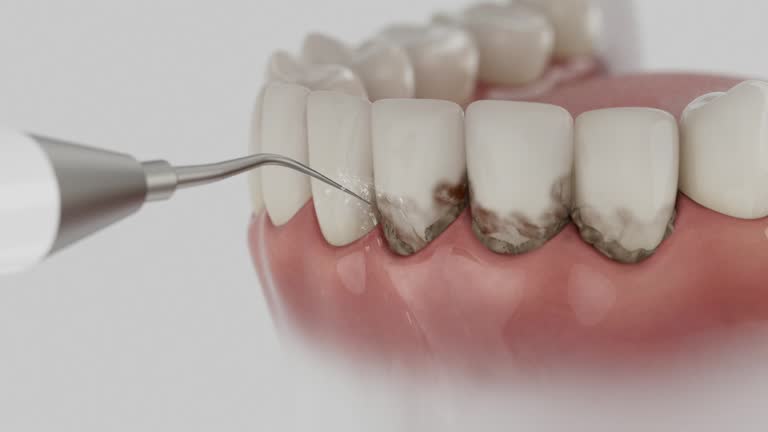 Trusted Wisdom Tooth Removal service in Brent, FL - Dentist Open Now